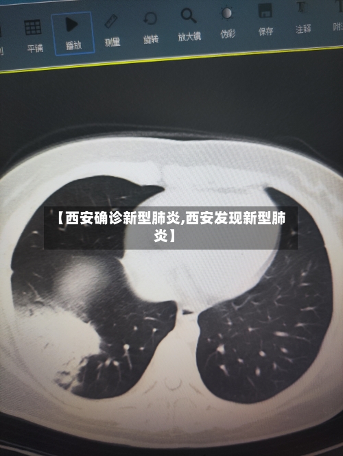 【西安确诊新型肺炎,西安发现新型肺炎】-第2张图片
